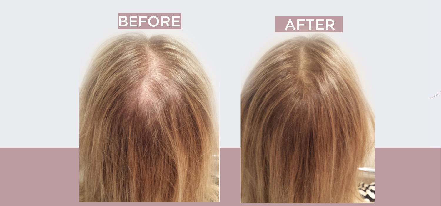 How to overcome hair loss in a female