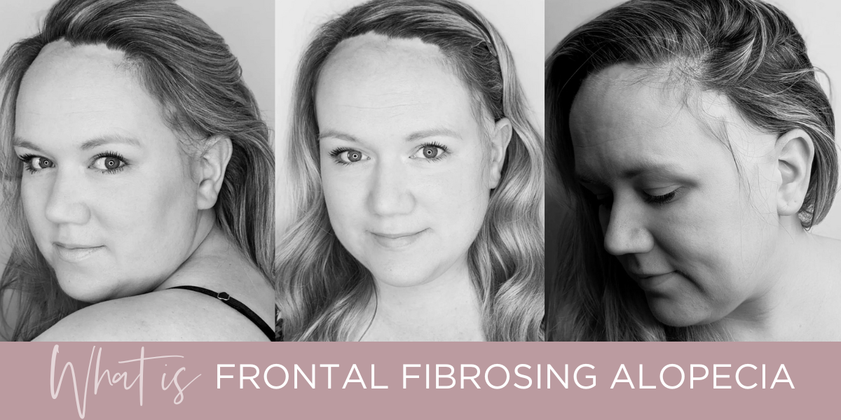 Frontal Fibrosing Alopecia Depression Of The Frontal Veins A New Frontal Fibrosing Alopecia Depression Of The Frontal Veins A New