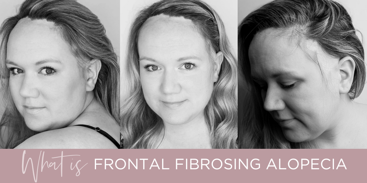 Frontal Fibrosing Alopecia | Interview with Rosemary